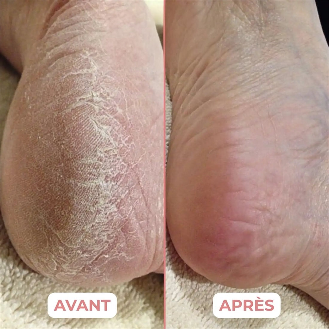 HoneyBalm® Baume hydratant au Miel pour les pieds