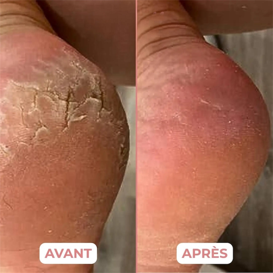 HoneyBalm® Baume hydratant au Miel pour les pieds